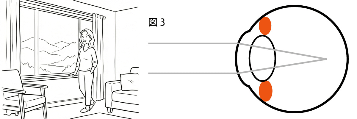 毛様体筋の緊張状態がゆずまず水晶体は厚いまま