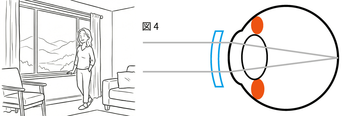 メガネ・コンタクトの矯正により、屈折率を変えてピントを調整