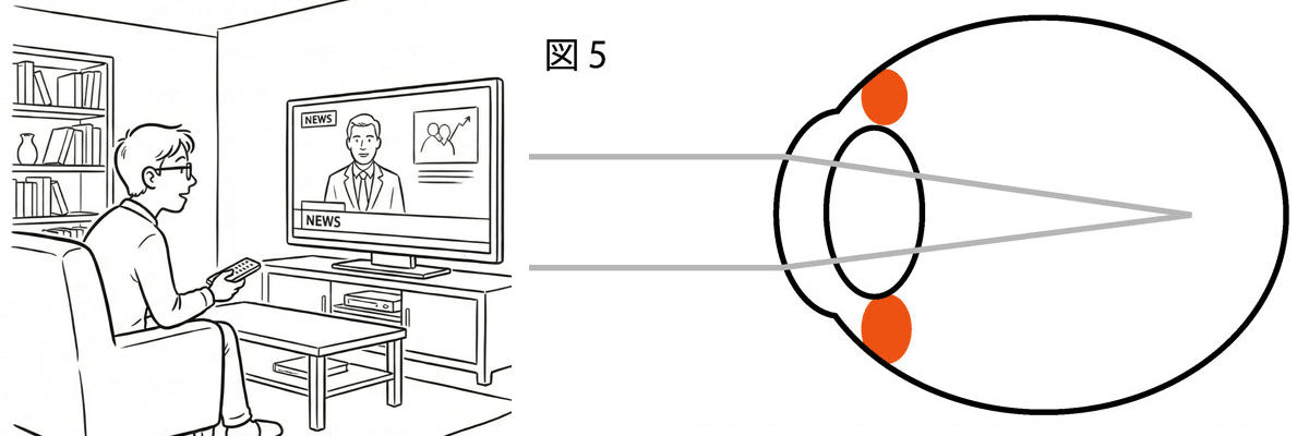 目が変形し、焦点が合わなくなった状態