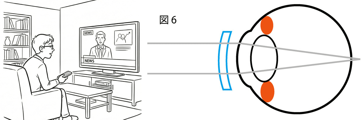 過度の矯正をしたまま、近くを見ている状態